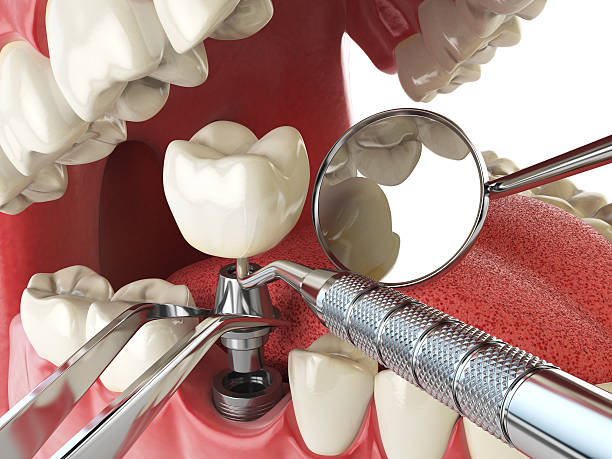 Best Emergency Tooth Extraction in Grafton, WI